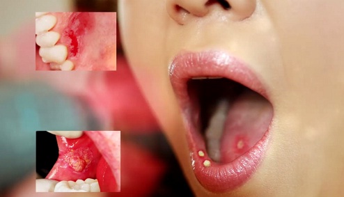 Một số bệnh thường gặp ở miệng